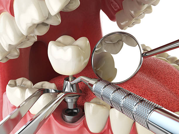 Best Emergency Dentist for Knocked-Out Tooth in Teviston, CA